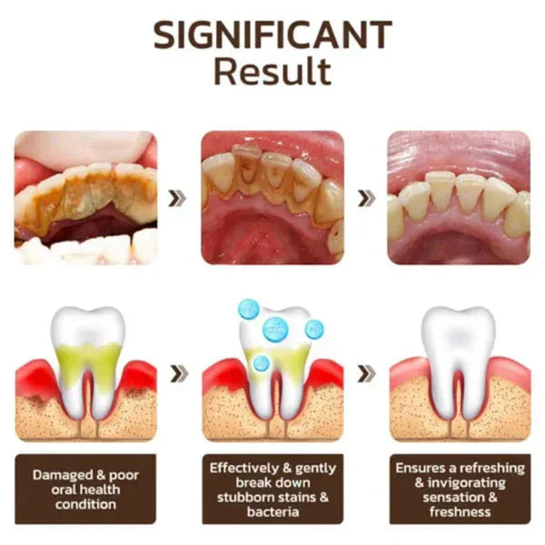 Dentifrice blanchissant probiotique SP-4  Gestion de la santé bucco-dentaire(Élimine des années de taches)