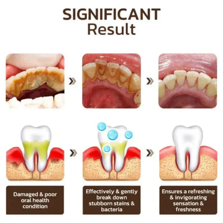 Dentifrice blanchissant probiotique SP-4  Gestion de la santé bucco-dentaire(Élimine des années de taches)